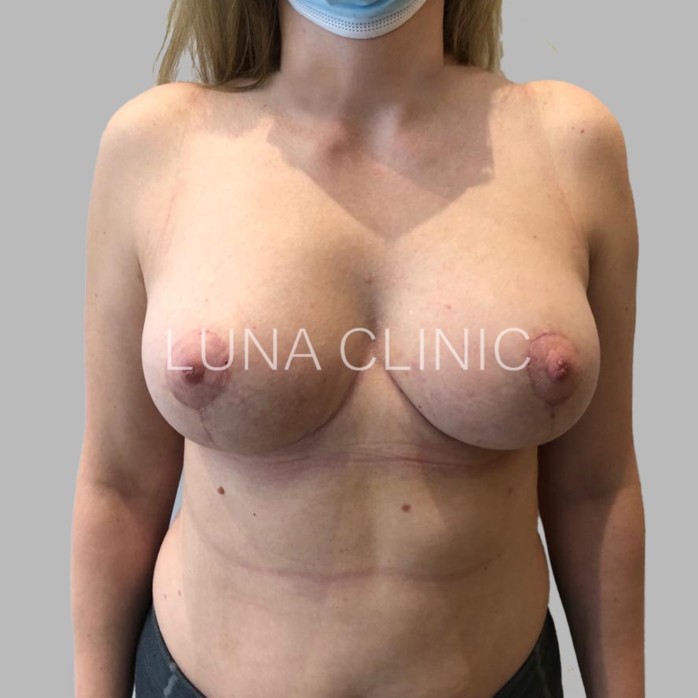 Breast reduction - po zabiegu, przypadek 4