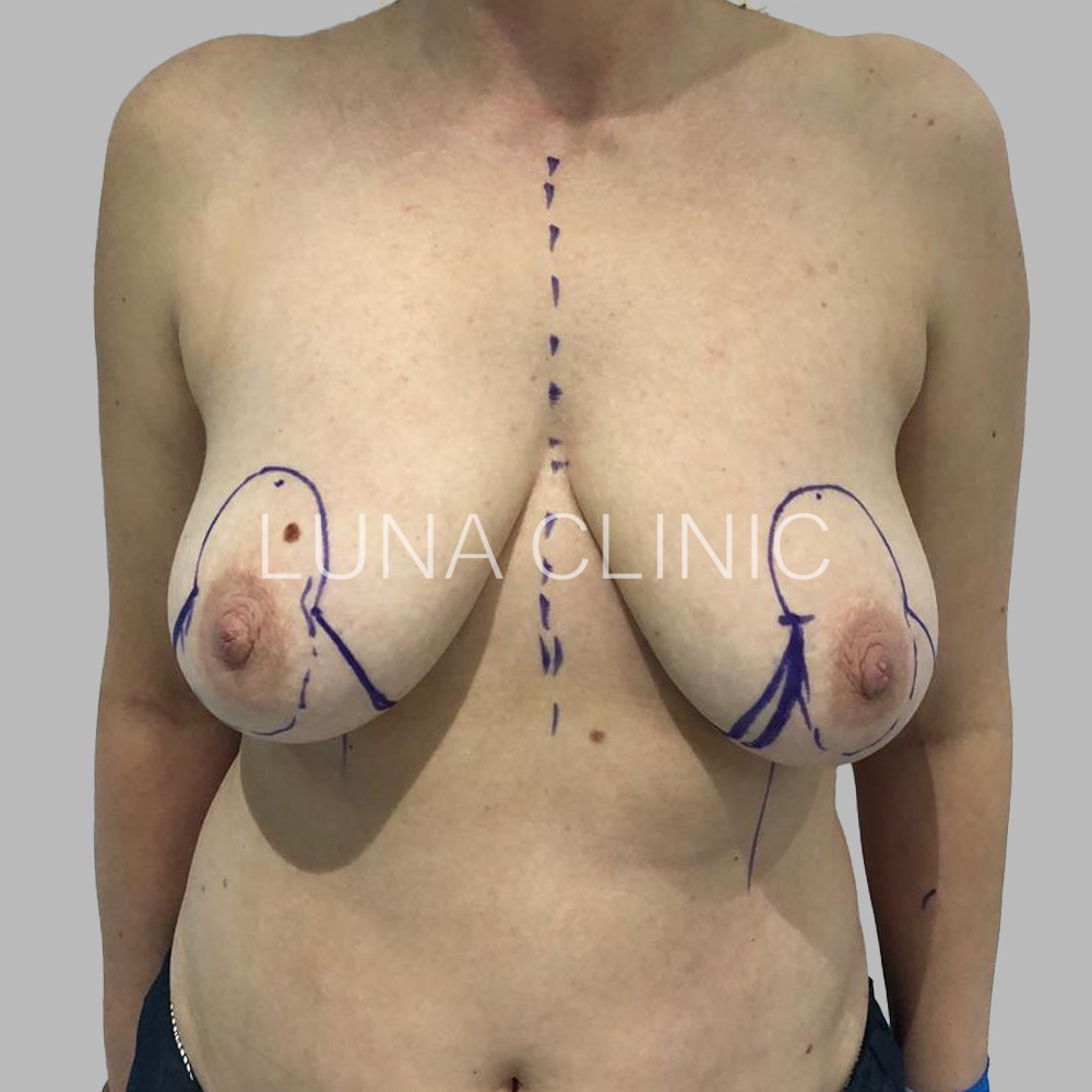 Breast reduction - przed zabiegiem, przypadek 4