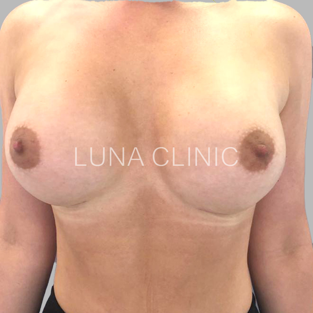 Breast augmentation - before and after results