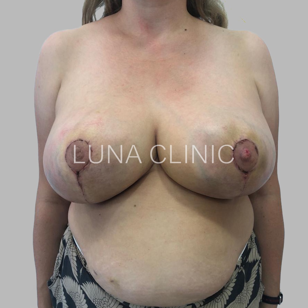Breast reduction - before and after results