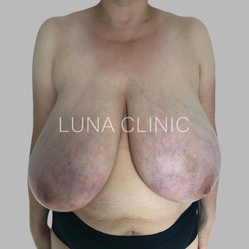 Breast reduction - przed zabiegiem, przypadek 1