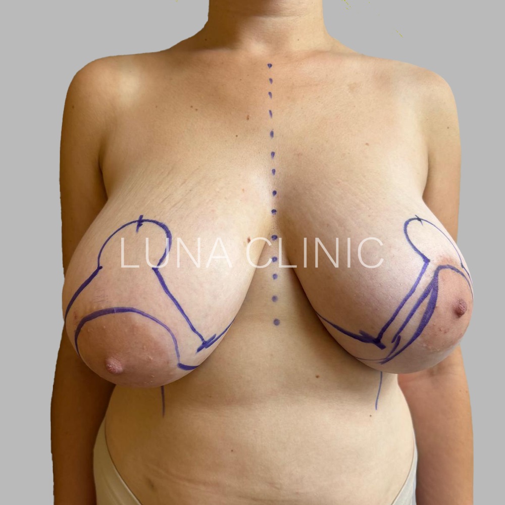 Breast reduction - przed zabiegiem, przypadek 2