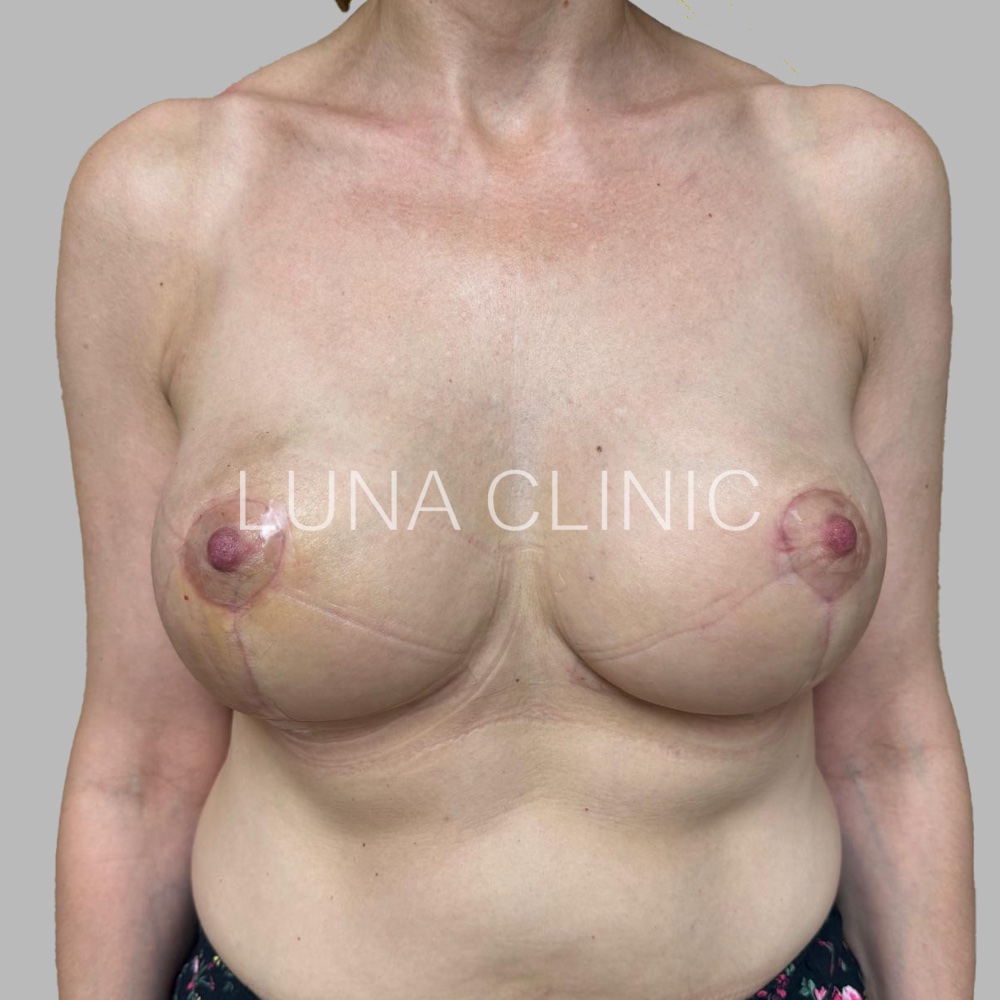 Breast reduction - po zabiegu, przypadek 3