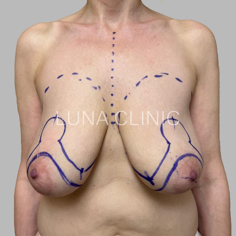 Breast reduction - przed zabiegiem, przypadek 3