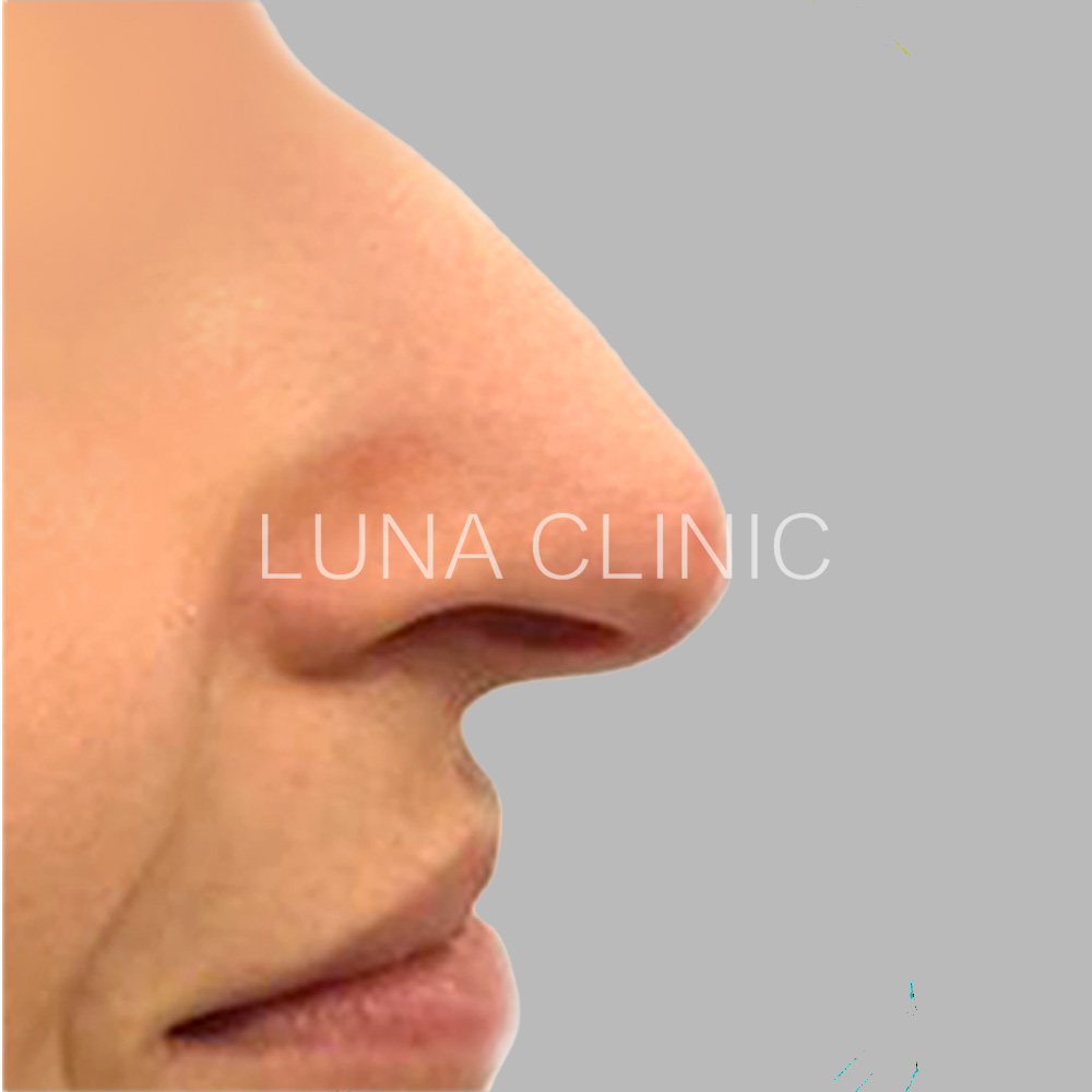 Nose reshaping - before the procedure, przypadek 1