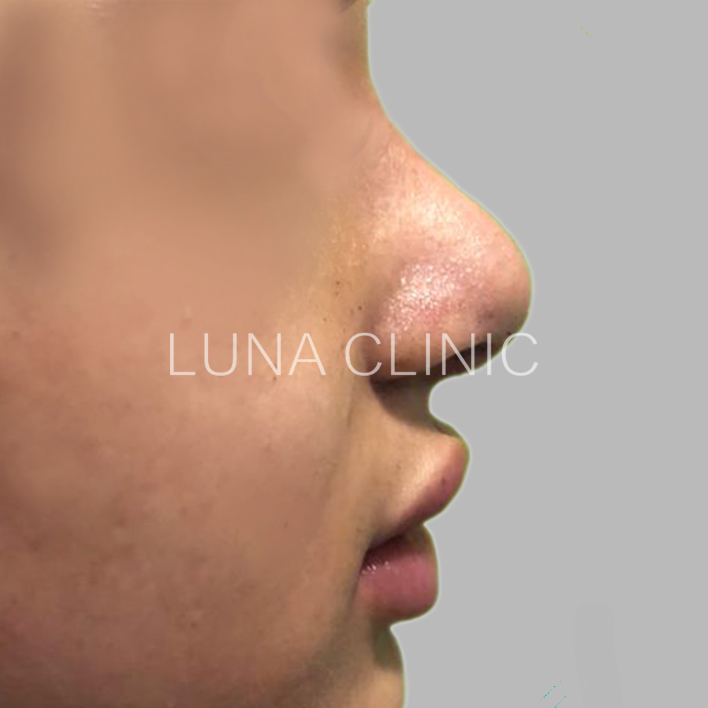 Nose reshaping - after the procedure, przypadek 2