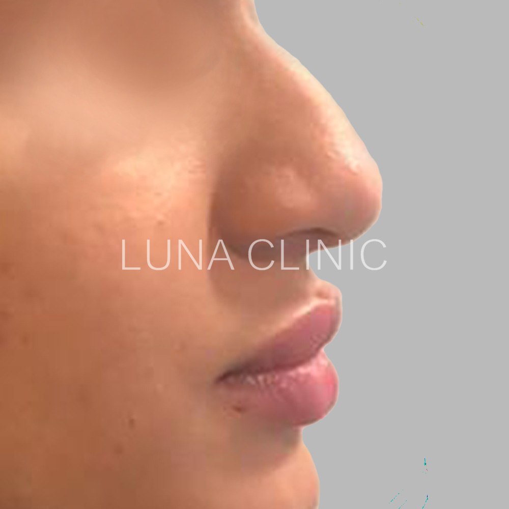Nose reshaping - before the procedure, przypadek 2