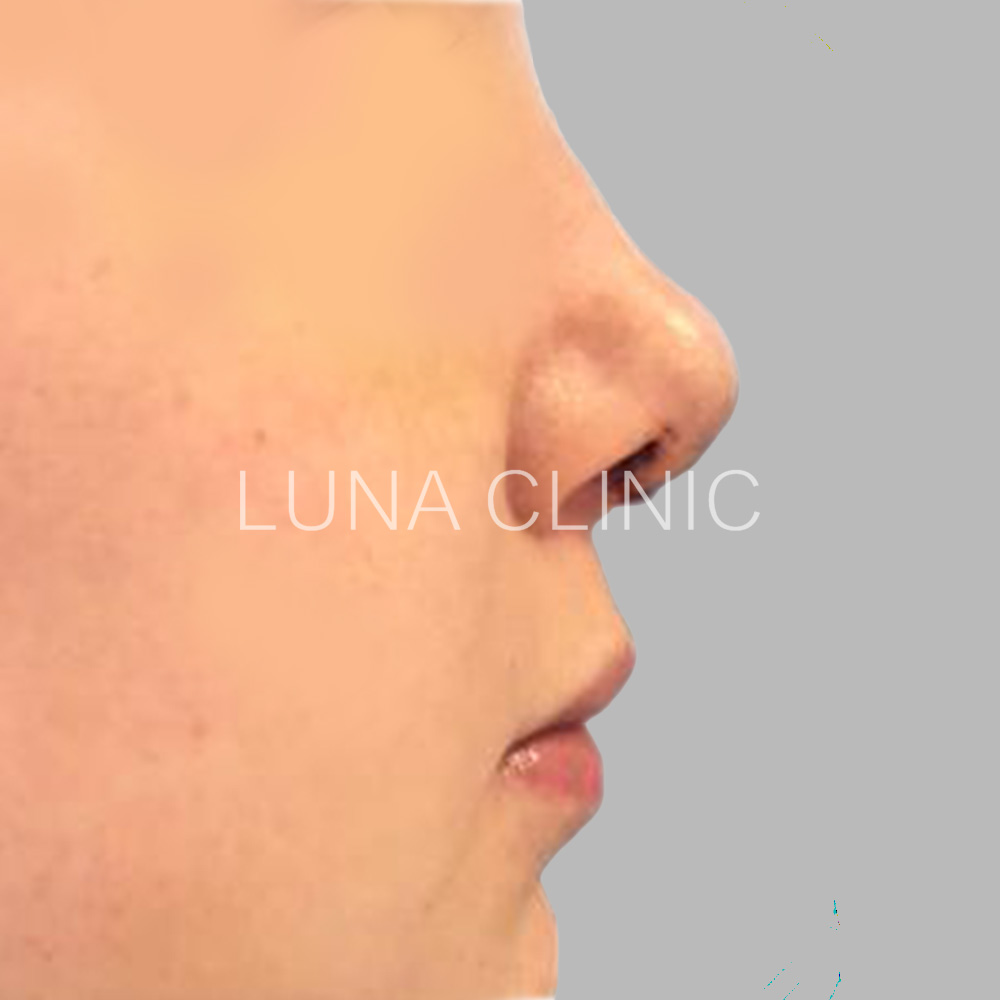 Nose reshaping - after the procedure, przypadek 3
