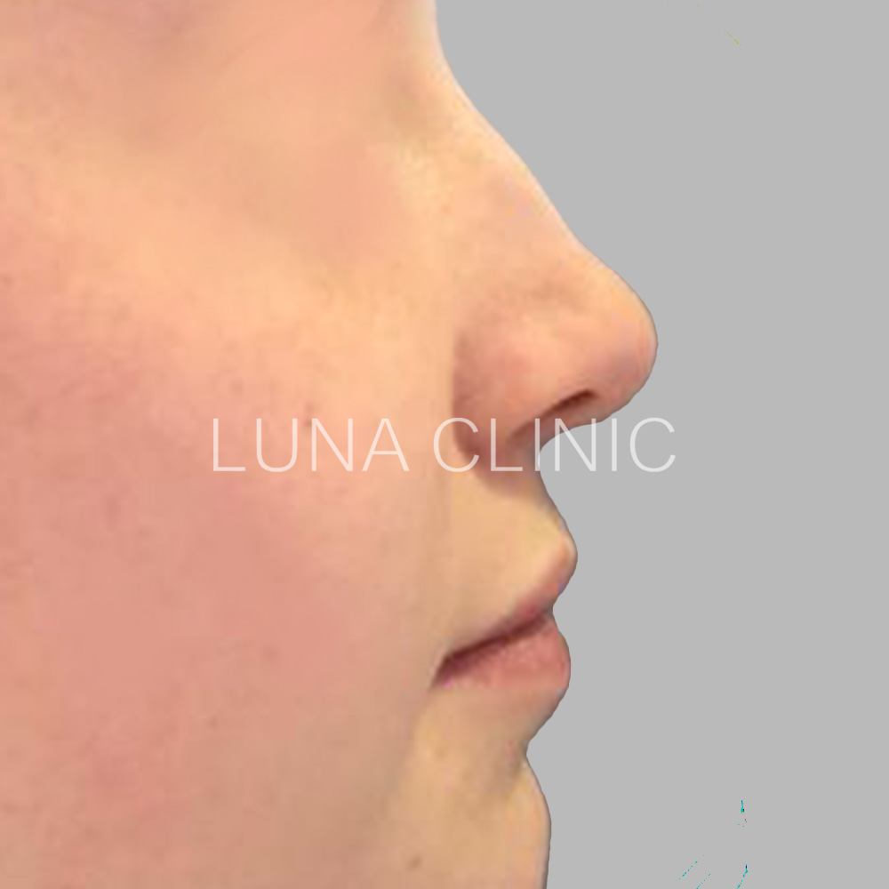 Nose reshaping - before the procedure, przypadek 3