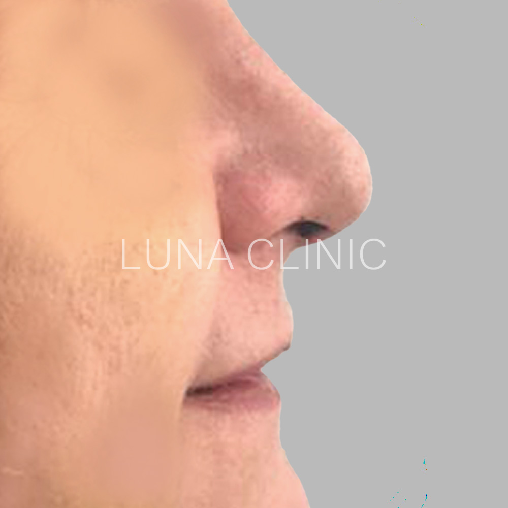 Nose reshaping - after the procedure, przypadek 4
