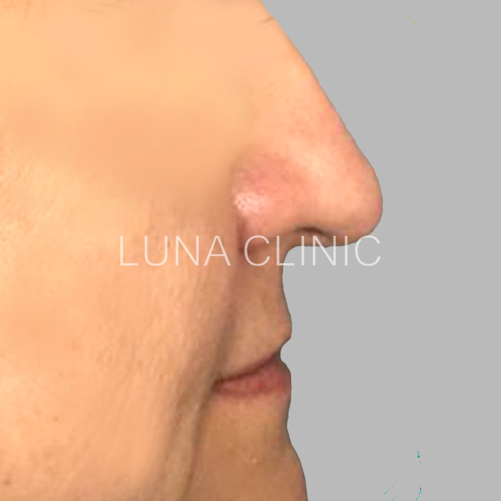 Nose reshaping - before the procedure, przypadek 4