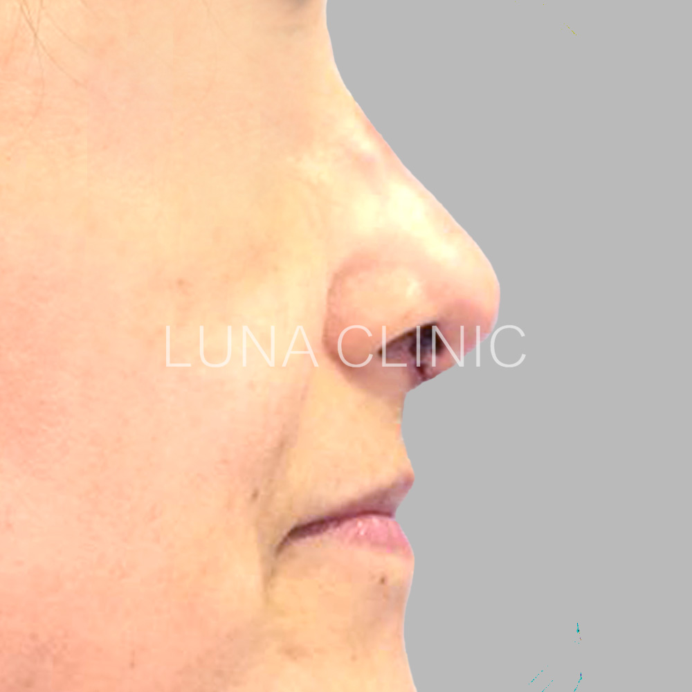 Nose reshaping - after the procedure, przypadek 5