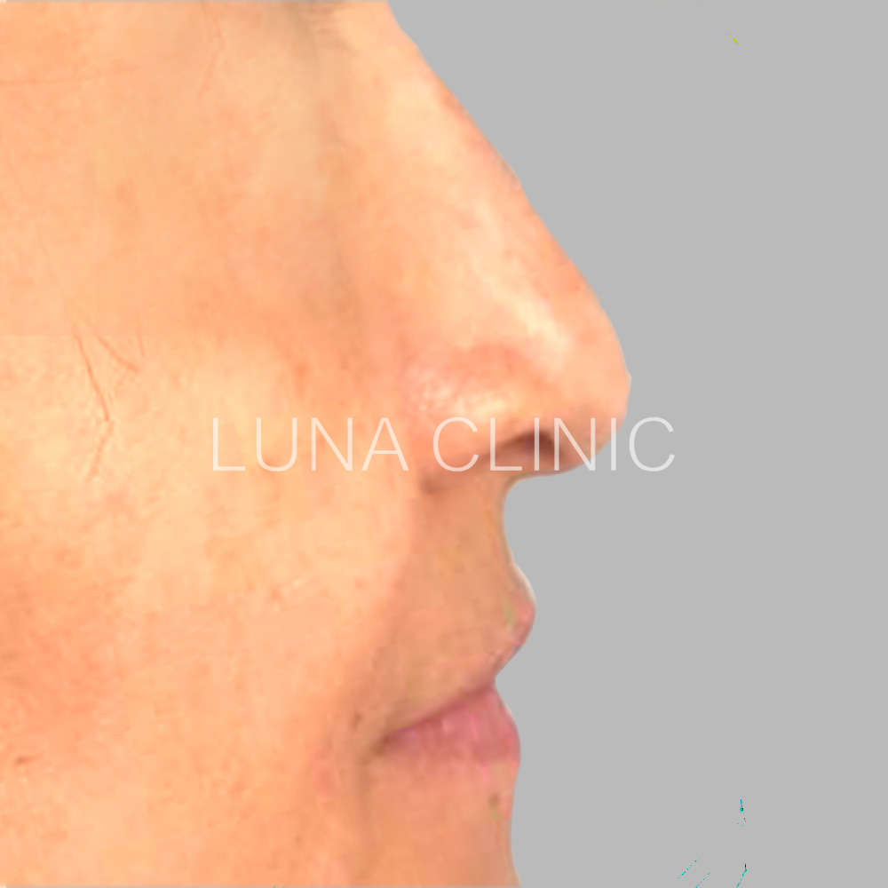 Nose reshaping - before the procedure, przypadek 5