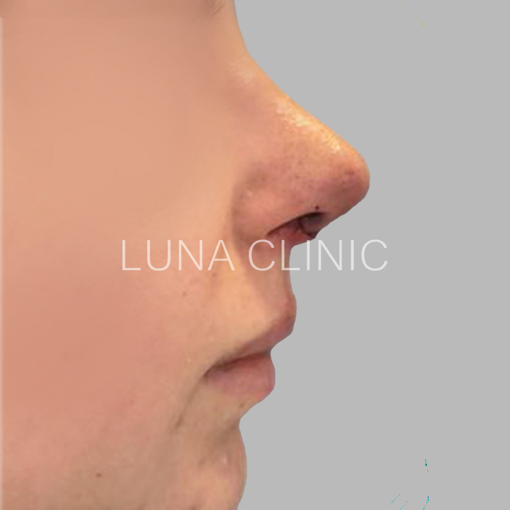 Nose reshaping - after the procedure, przypadek 6
