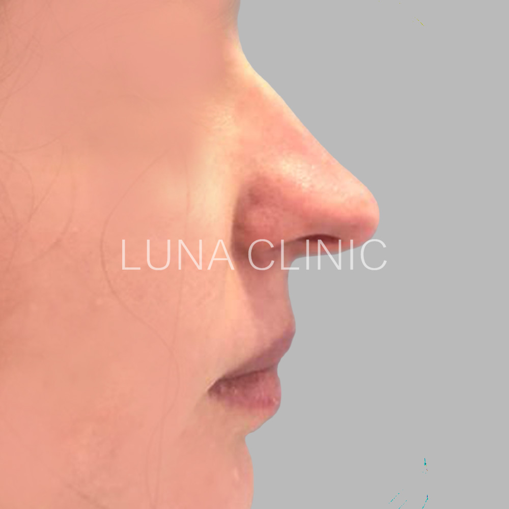 Nose reshaping - before the procedure, przypadek 6