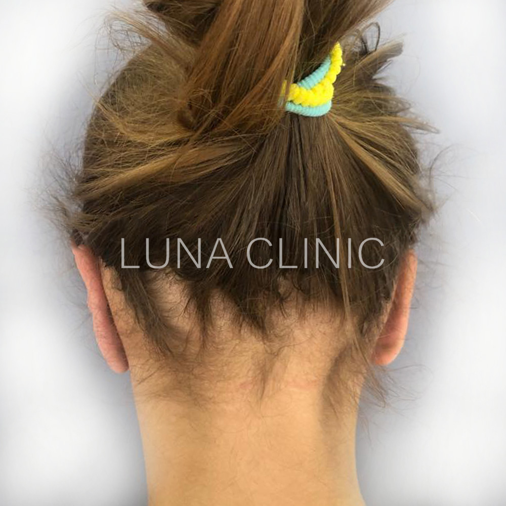 Prominent ear correction - before and after results
