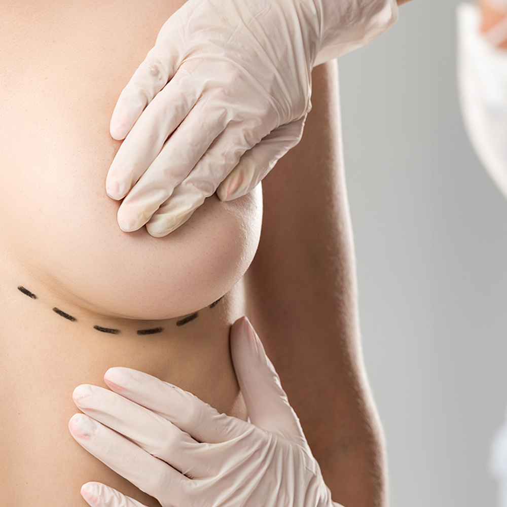 Lipofilling – przeszczep tłuszczu jako alternatywa dla implantów, analiza badań, skuteczność i trwałość wyników. Chirurgia plastyczna Wrocław.