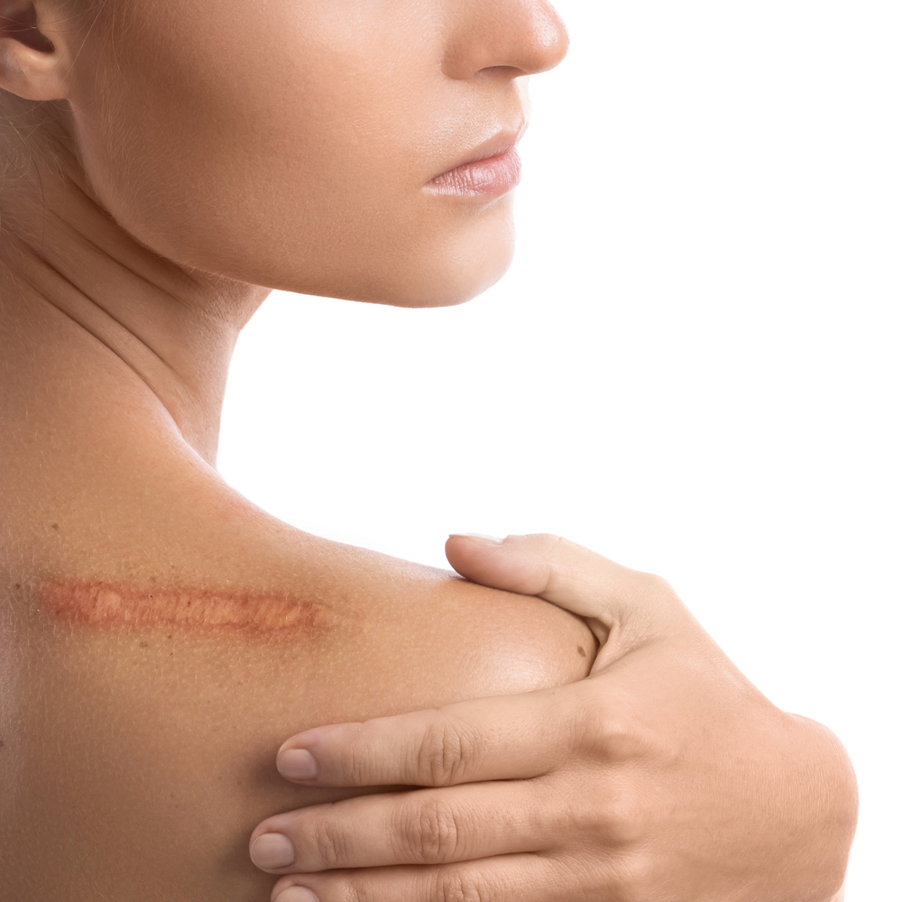 Przegląd najnowszych metod leczenia blizn – technologie, skuteczność i wyniki badań wspierające regenerację skóry. Chirurgia plastyczna Wrocław.