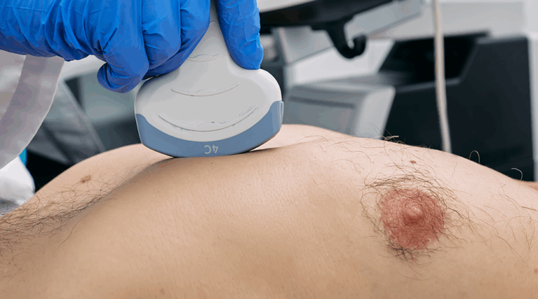 ginekomastii ginekomastii