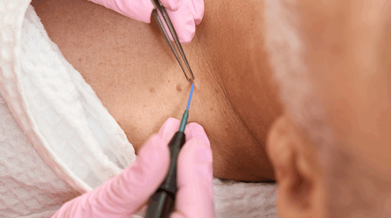 usuwanie znamion usuwanie znamion